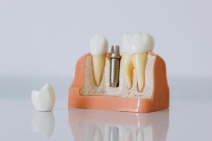 kiekkainuojadantuimplantaidetalusvadovasirkainupalyginimas